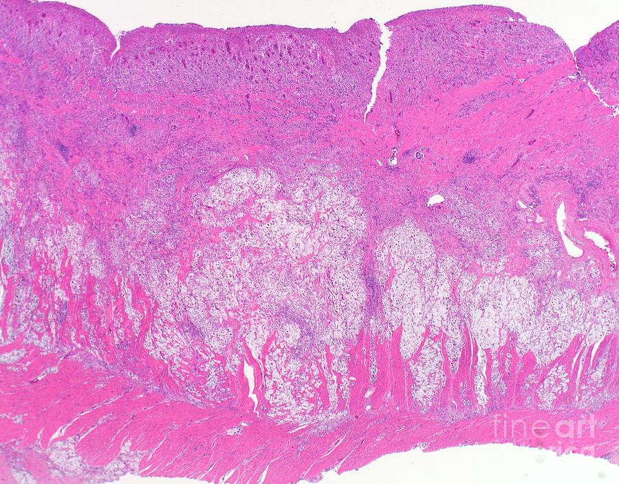 Signet Ring Cell Carcinoma Of The Colon Photograph by Webpathology ...