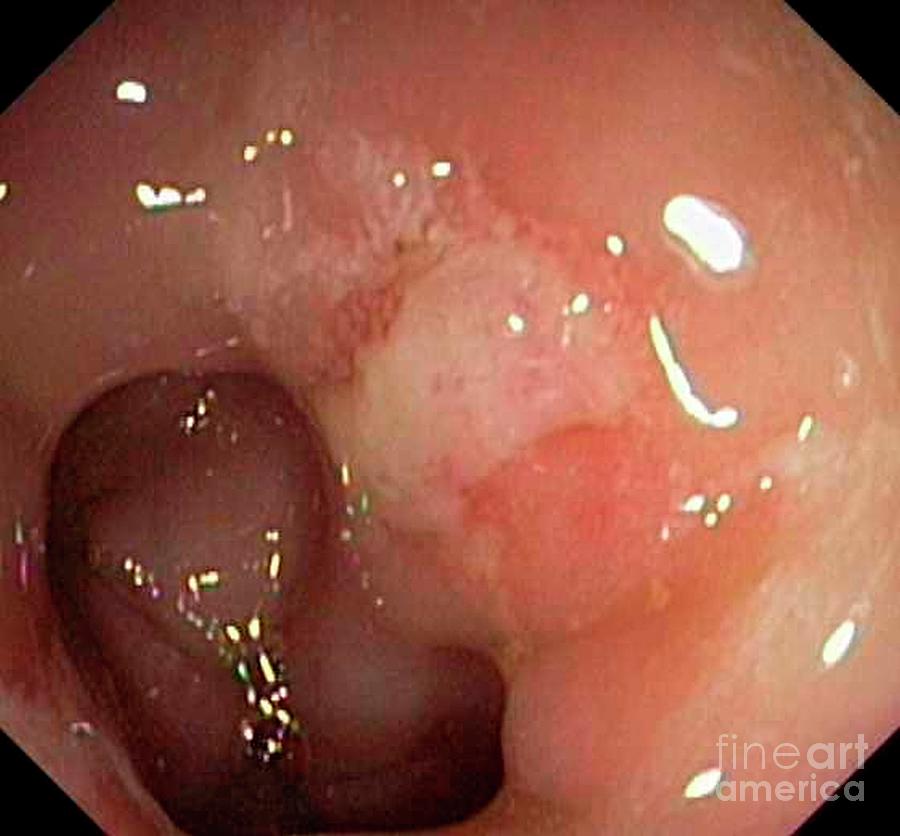 Solitary Rectal Ulcer Syndrome #1 Photograph by Gastrolab/science Photo Library
