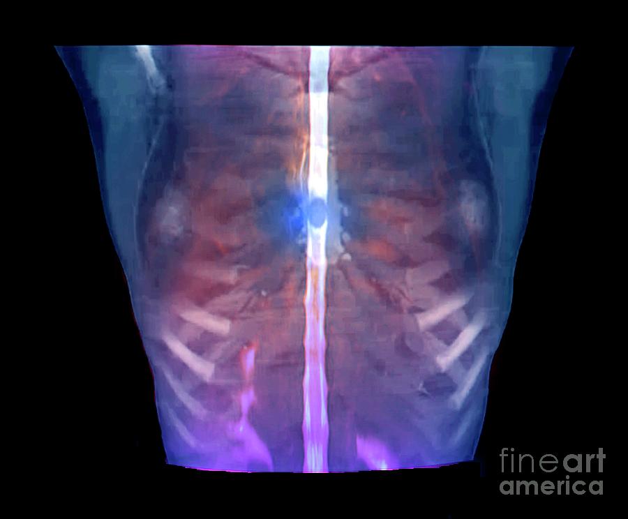 Spinal Cord Tumour #1 Photograph by Zephyr/science Photo Library