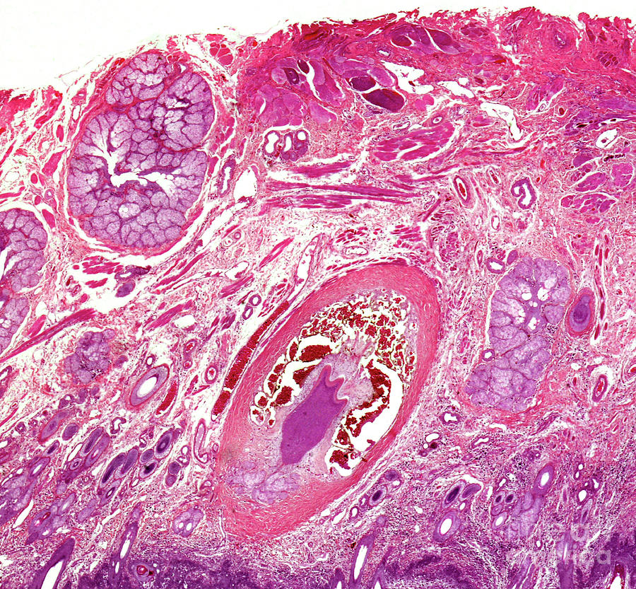 Squamous Cell Carcinoma Photograph By Nigel Downer Science Photo Library Pixels