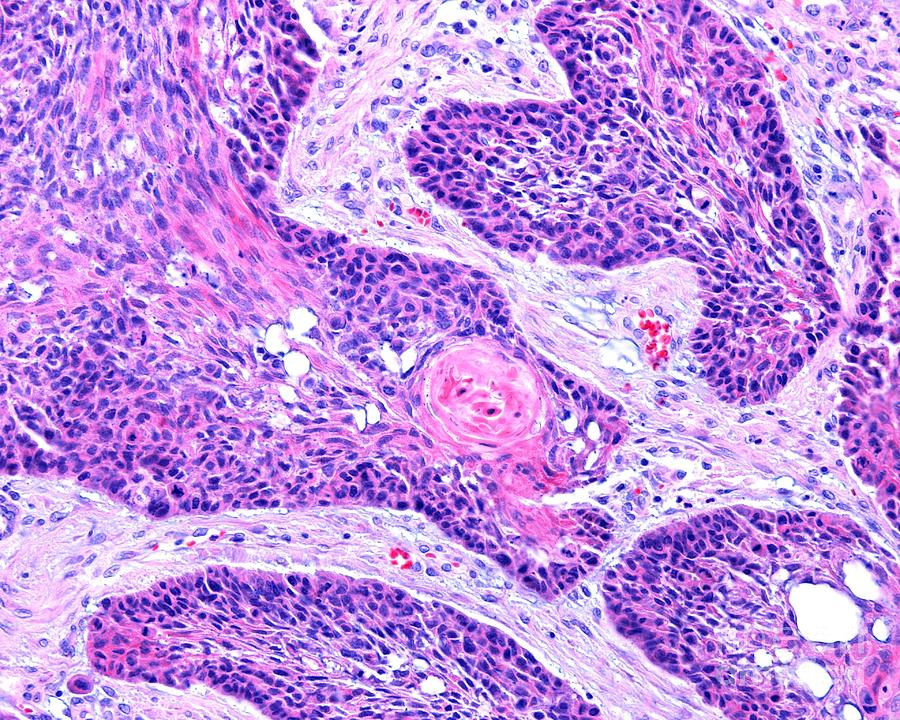 Squamous Cell Carcinoma Of The Larynx Photograph By Jose Calvo