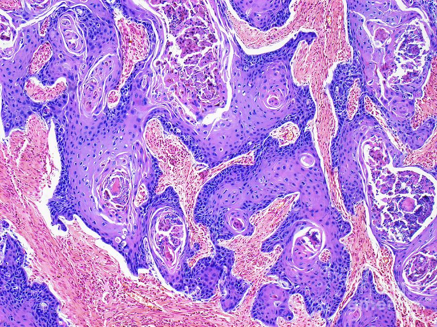 Cancer Photograph - Squamous Cell Carcinoma Of The Vulva #1 by Steve Gschmeissner/science Photo Library