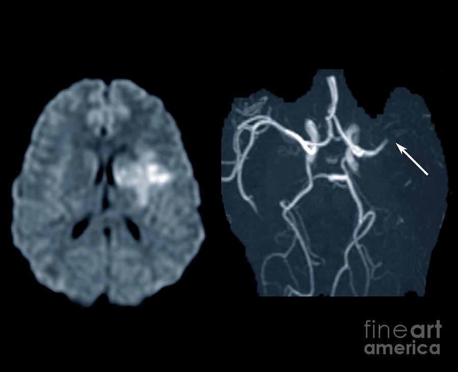 Stroke Caused By A Thrombosis #1 Photograph by Zephyr/science Photo Library
