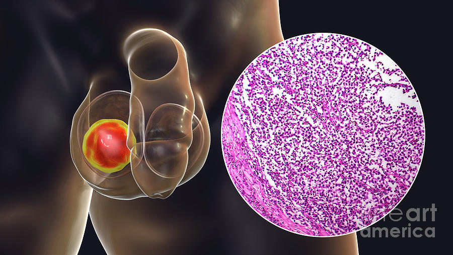 Testicular Cancer Photograph by Kateryna Kon/science Photo Library ...