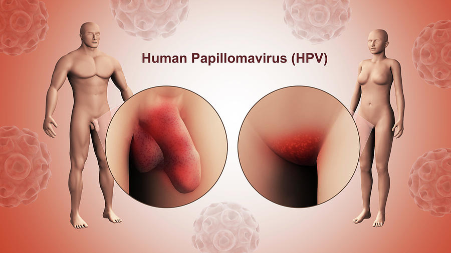 The Human Papillomavirus Infection Hpv #1 Photograph by Stocktrek Images