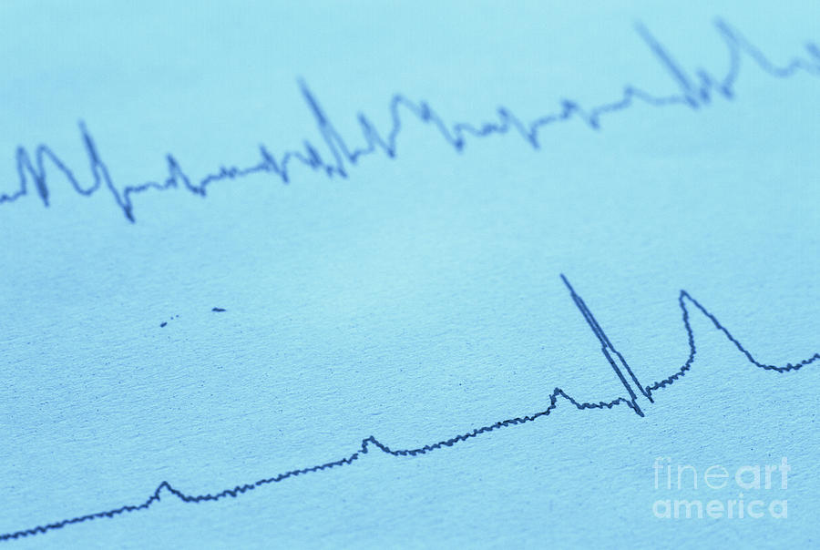 Thirddegree Heart Block Photograph by Daniel Sambraus/science Photo