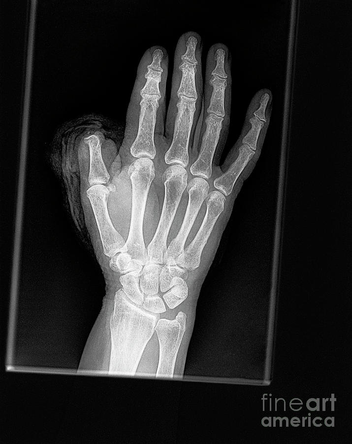 Thumb Amputation Injury Photograph by Science Photo Library - Fine Art ...