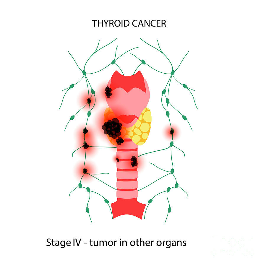 Thyroid Cancer Photograph by Pikovit / Science Photo Library - Fine Art ...