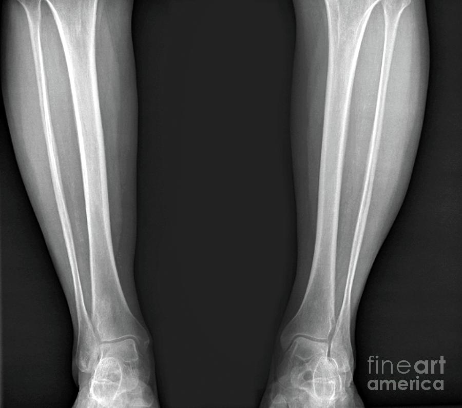 Tibial Deviation #1 Photograph by Zephyr/science Photo Library - Pixels