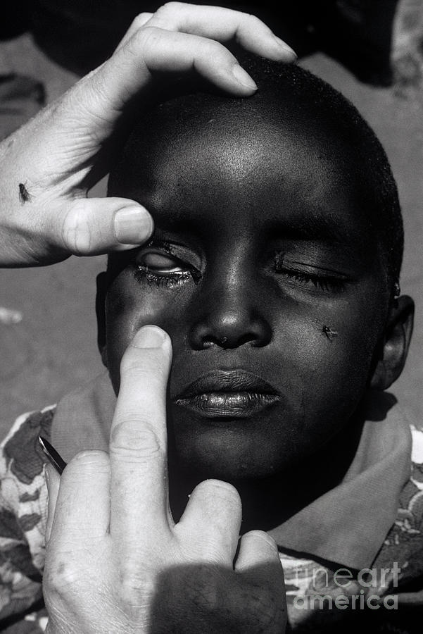 Trachoma Eye Infection Treatment #1 Photograph by Jason Kelvin/science Photo Library