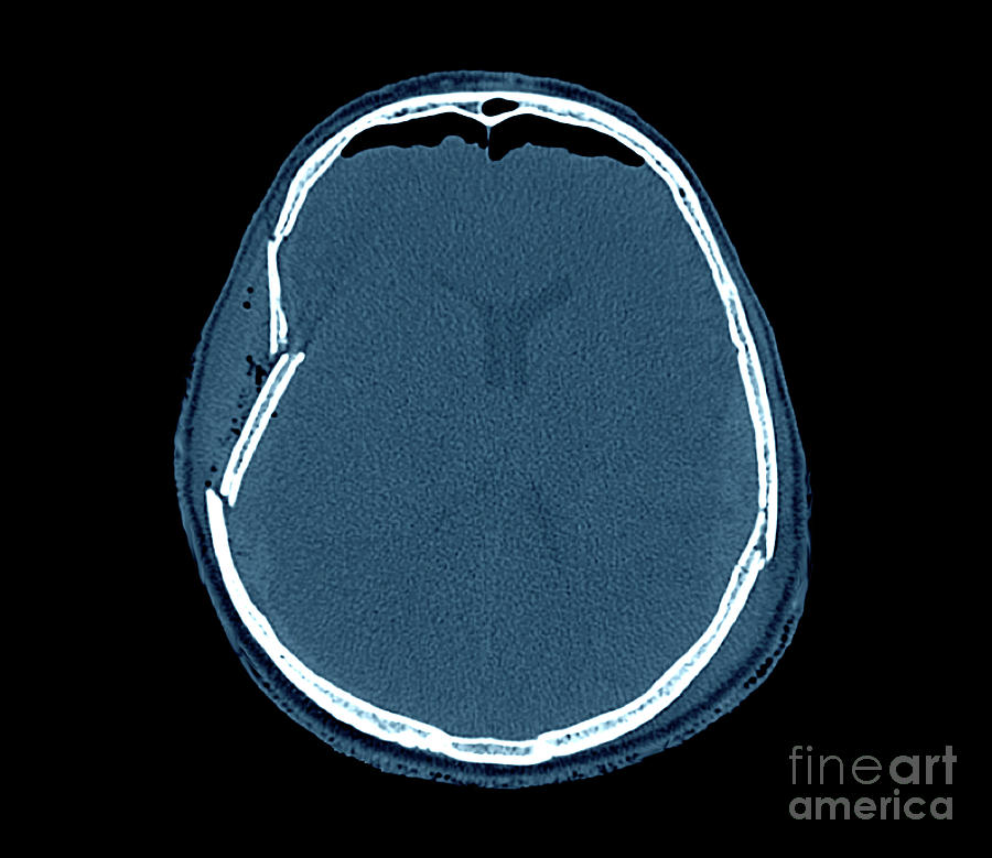 Traumatic Brain Injury Photograph by Zephyr/science Photo Library