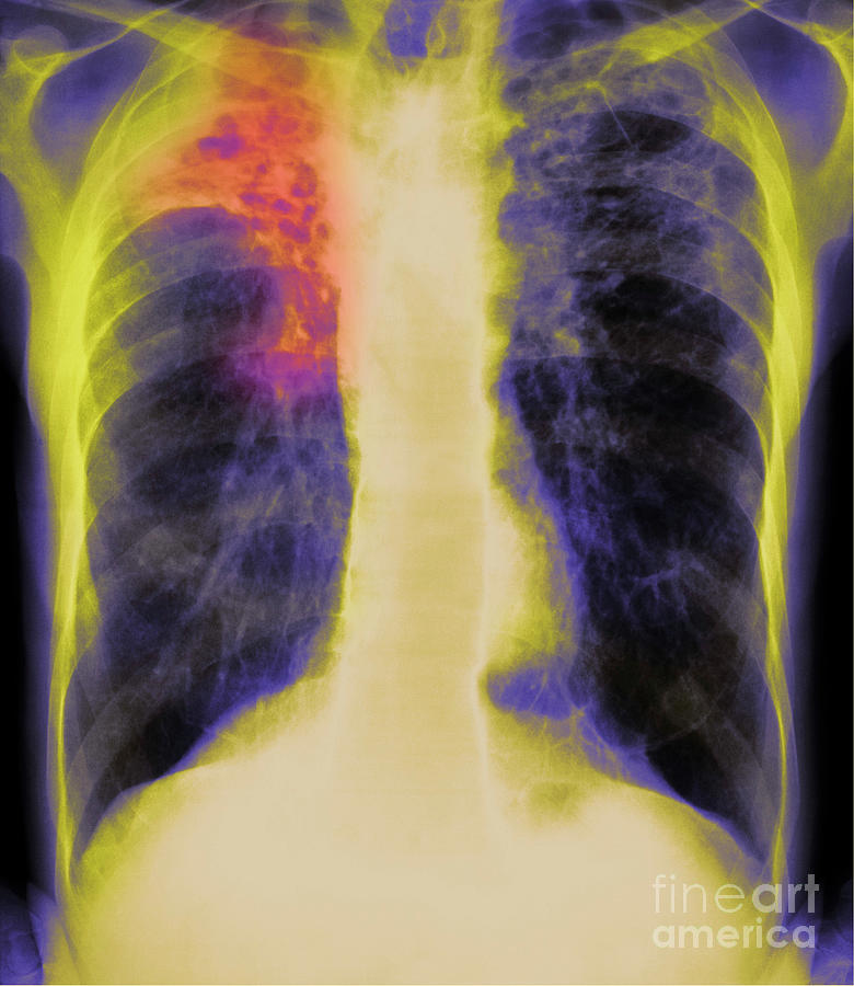 Tuberculosis X-ray #1 by Simon Fraser/science Photo Library