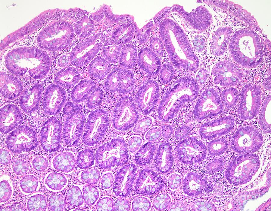 Tubular Colon Polyp Photograph By Webpathology Science Photo Library