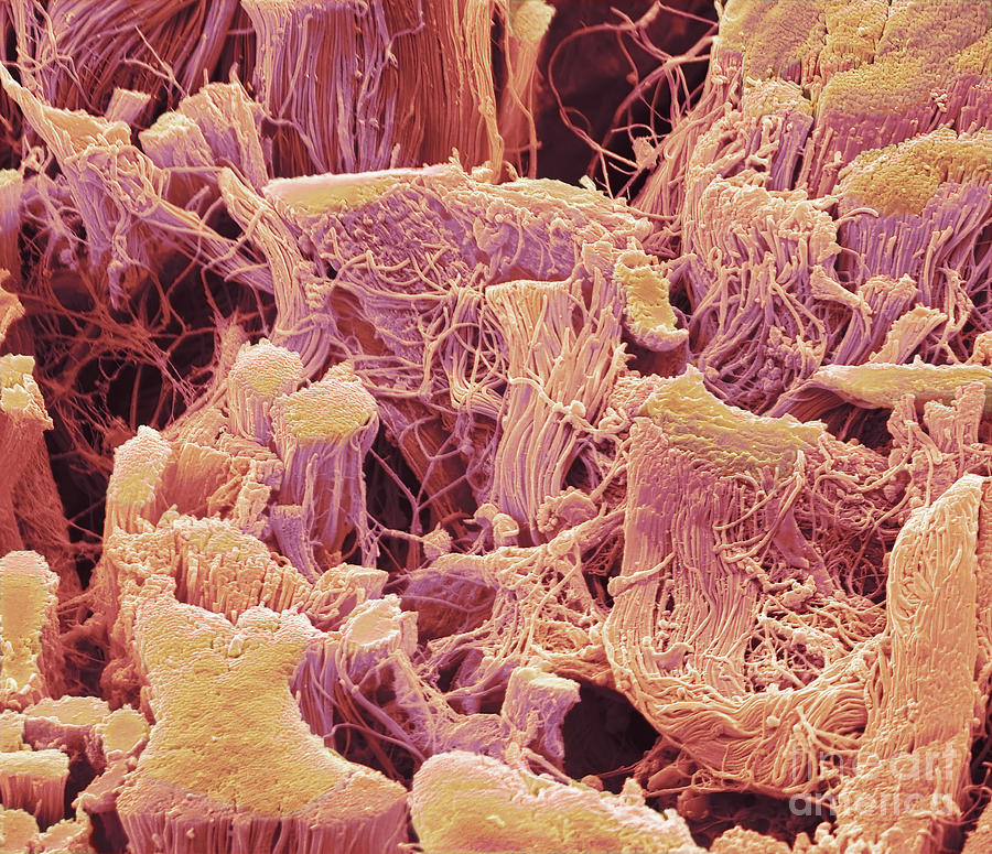 Tumour Connective Tissue #1 Photograph by Steve Gschmeissner/science Photo Library