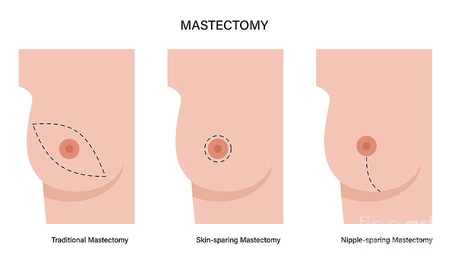 Types Of Female Mastectomy #1 by Pikovit / Science Photo Library
