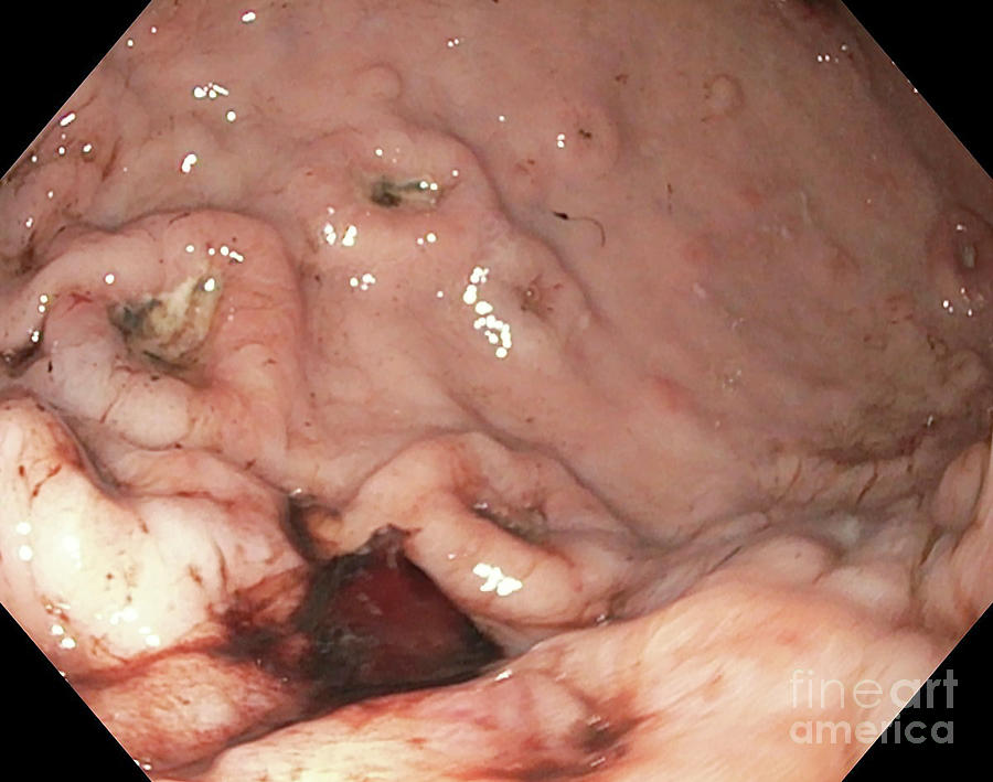 Disease Photograph - Ulceration In Gastric Lymphoma #1 by Gastrolab/science Photo Library