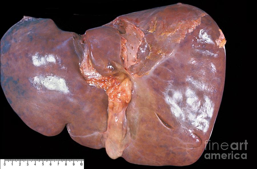 Unhealthy Human Liver #1 Photograph by Jose Calvo / Science Photo Library