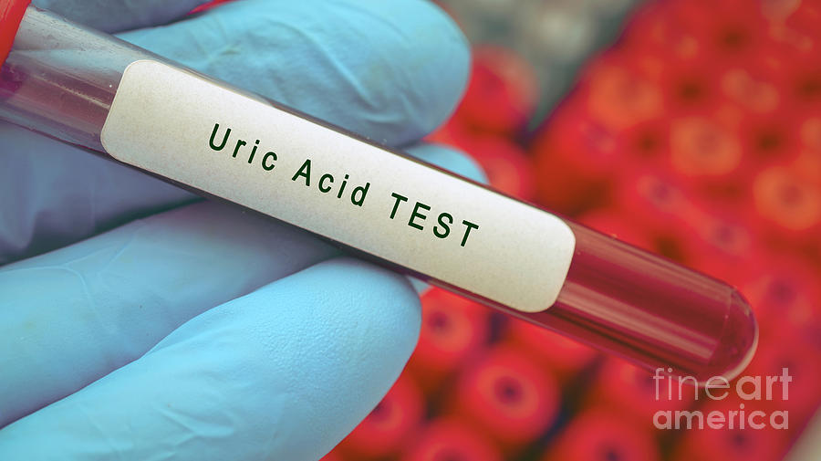 Uric Acid Blood Test #1 Photograph by Wladimir Bulgar/science Photo Library
