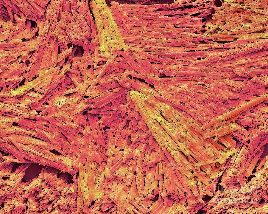 Uric Acid Crystals In Gout Photograph by Steve Gschmeissner/science Photo Library