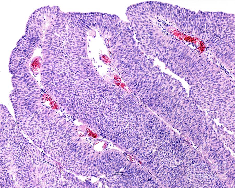 Urinary Bladder Papilloma #1 by Jose Calvo/science Photo Library