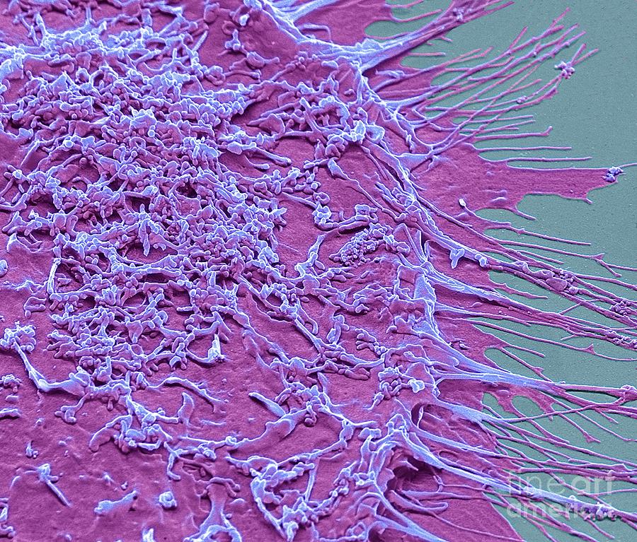 Vaginal Cancer Cells #1 Photograph by Steve Gschmeissner/science Photo Library