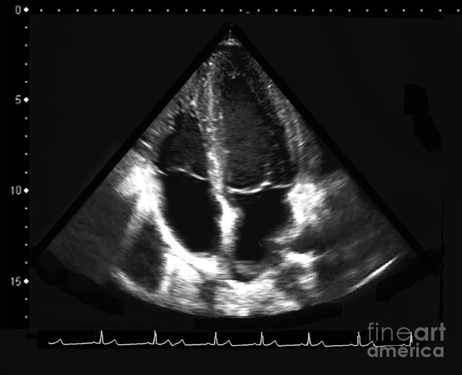 Ventricular Enlargement #1 Photograph by Zephyr/science Photo Library