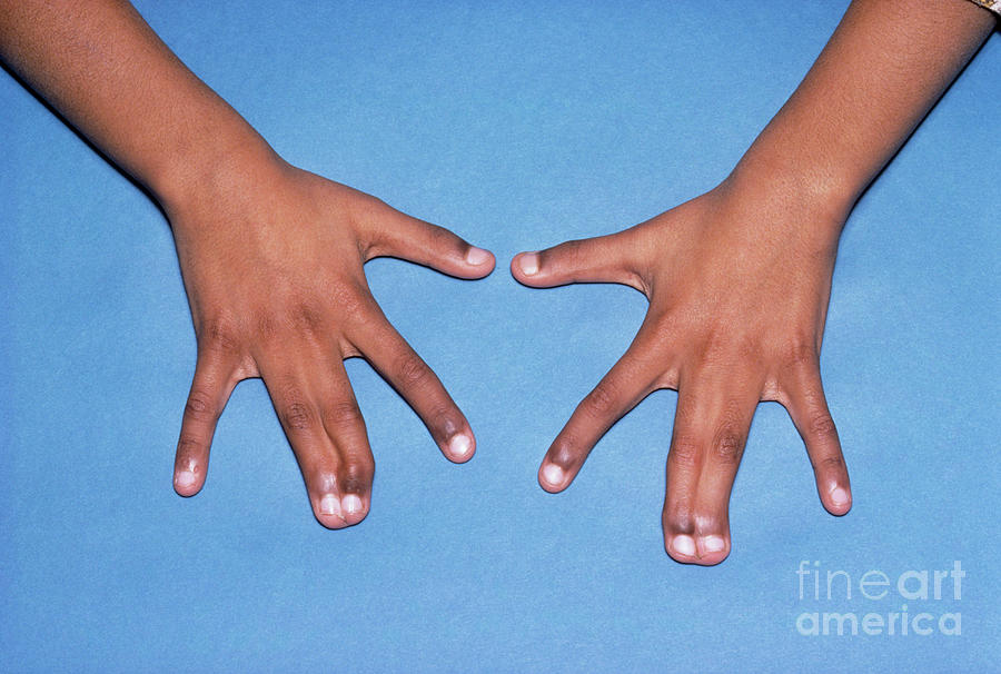 Webbed Fingers #1 Photograph by St Bartholomew Hospital/science Photo Library