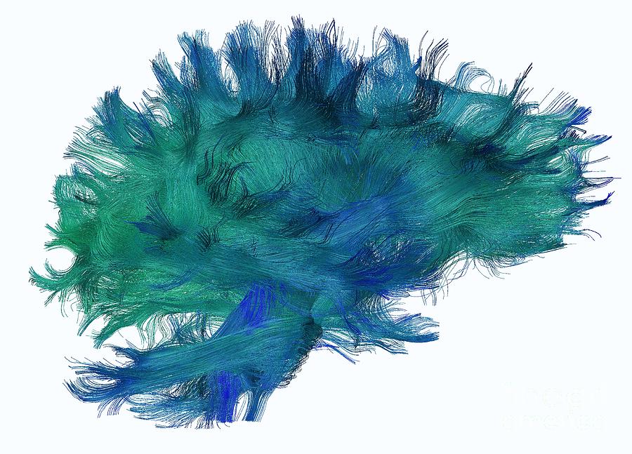 White Matter Fibres #1 Photograph by Do Tromp/science Photo Library