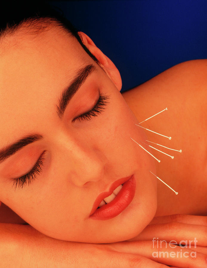 Woman With Acupuncture Needles In Cheek #1 by Science Photo Library