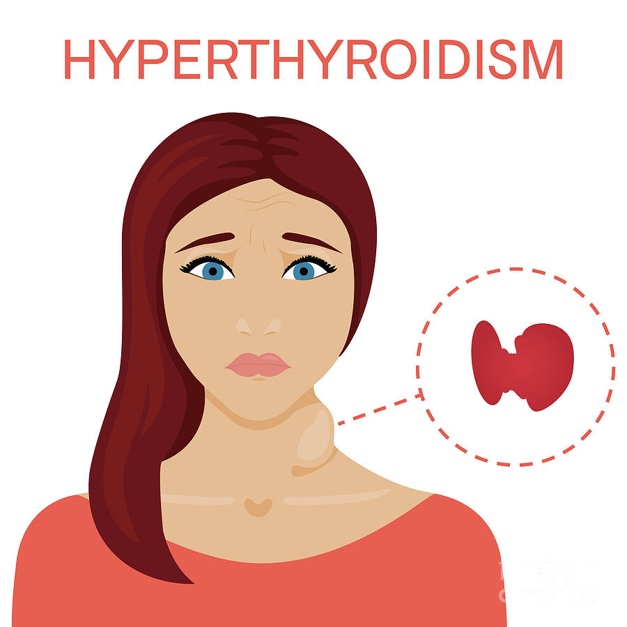 Woman With Hyperthyroidism Photograph by Art4stock/science Photo ...