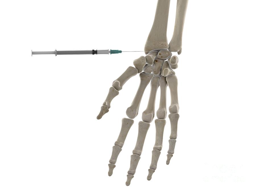 Wrist Injection #1 Photograph by Sebastian Kaulitzki/science Photo ...