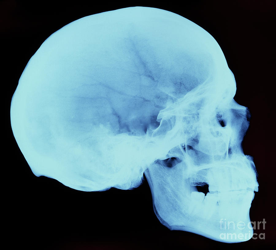 X-ray Of Human Skull #1 Photograph by D. Roberts/science Photo Library