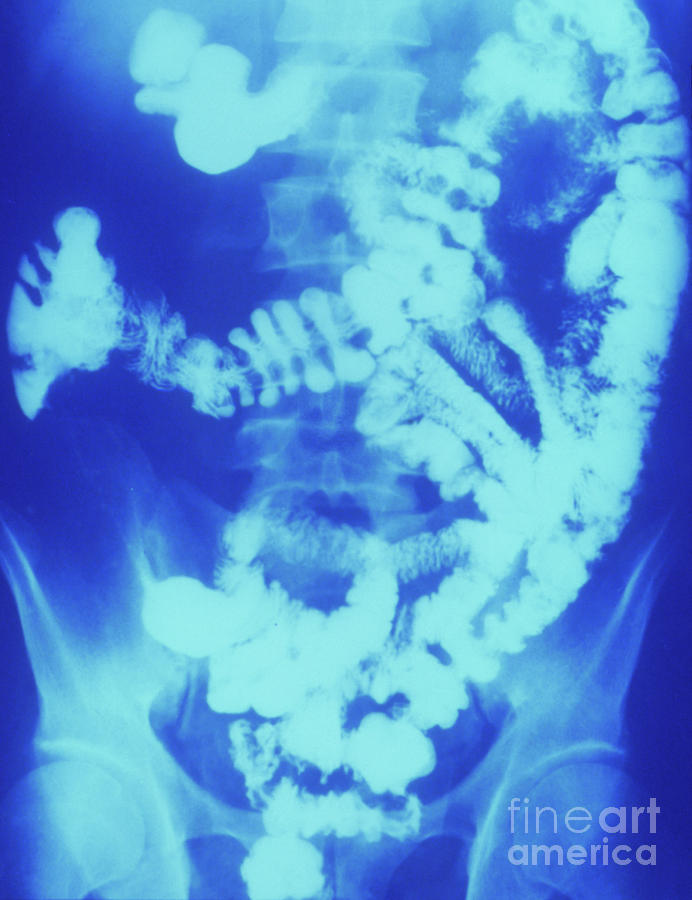 X-ray Of The Lower Gut In Crohn's Disease Photograph by St Bartholomew ...