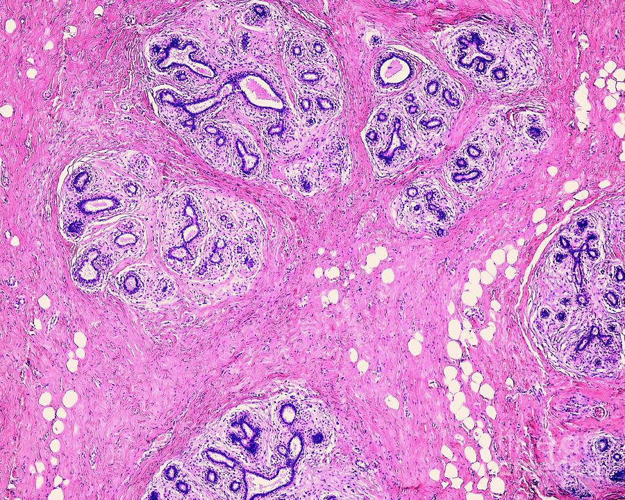 Adenosis Of Human Breast #10 Photograph by Jose Calvo/science Photo Library