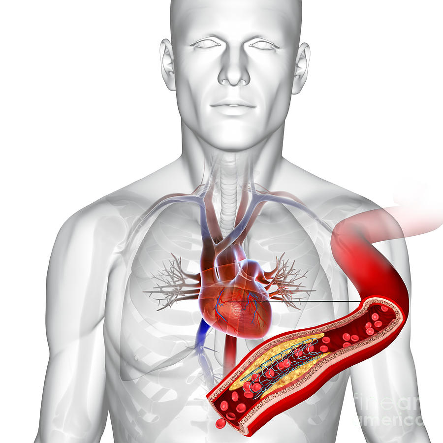 Angioplasty With Stent Placement Photograph By Fernando Da Cunha 