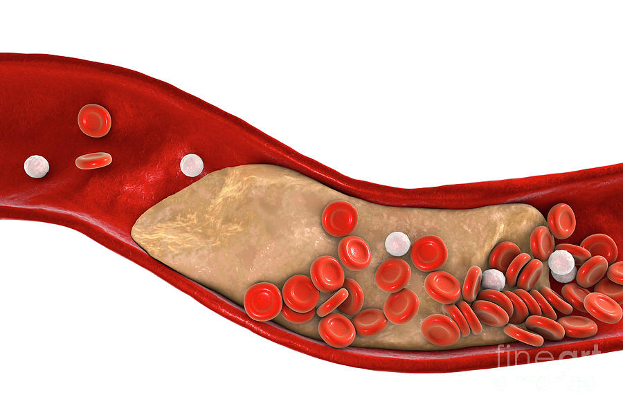 Atheromatous Plaque In Artery Photograph by Kateryna Kon/science Photo ...