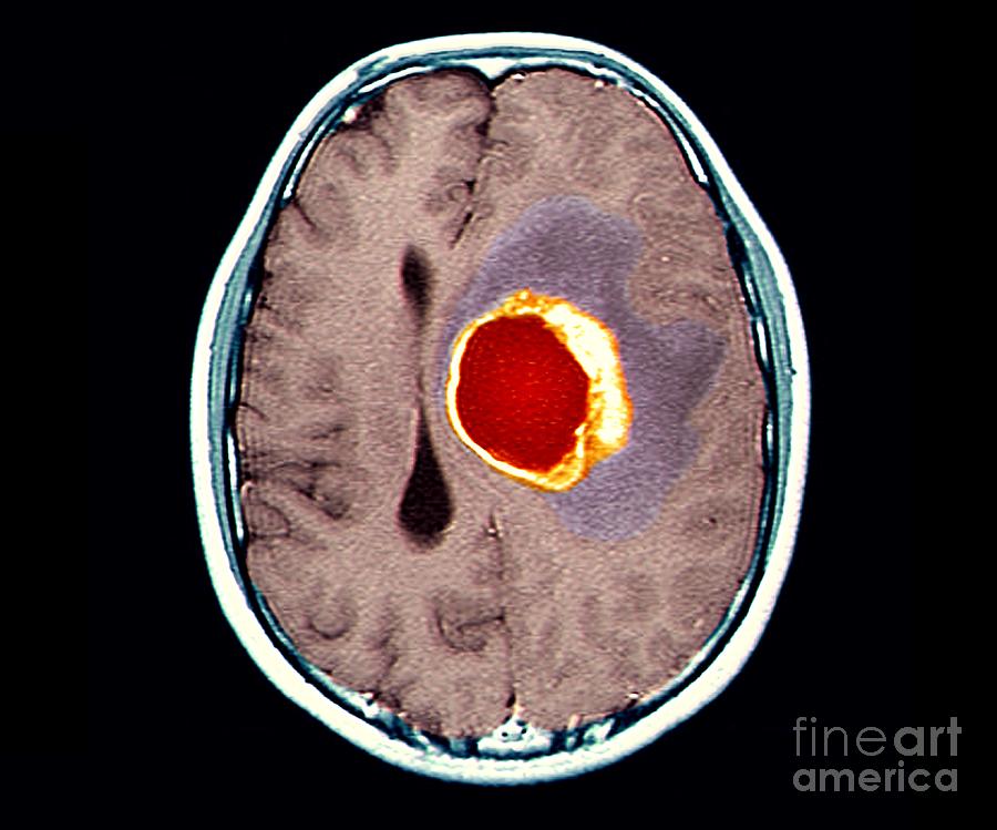 Brain Cancer Photograph by Zephyr/science Photo Library - Fine Art America