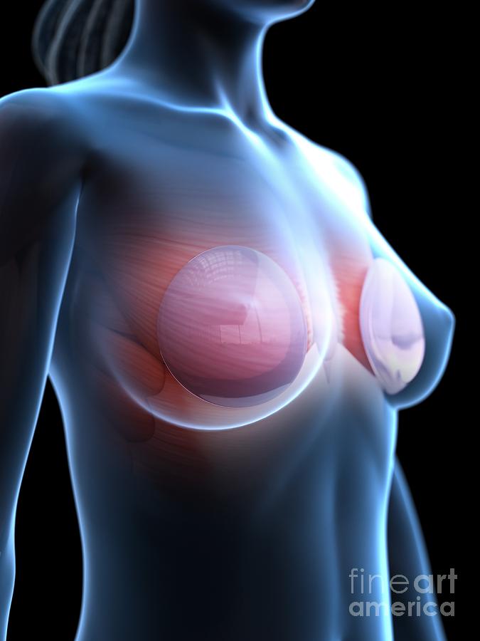 Breast Implants #10 Photograph by Sebastian Kaulitzki/science Photo Library