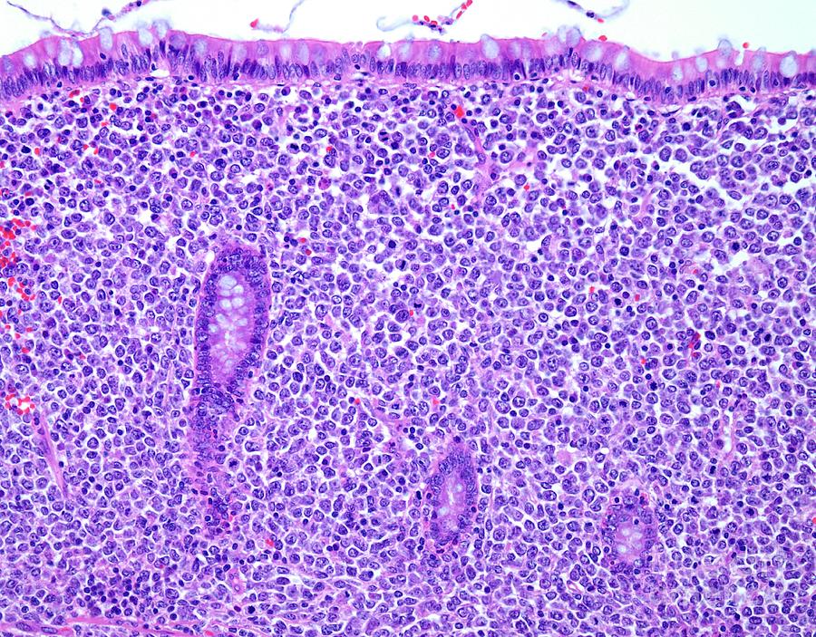 Diffuse Large B-cell Lymphoma Photograph By Webpathology/science Photo ...