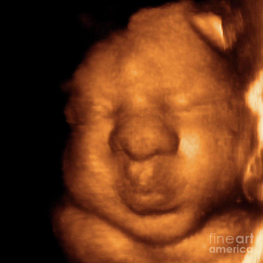 Foetus' Face #10 Photograph by Dr Najeeb Layyous/science Photo Library ...