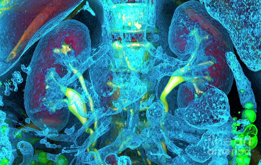 Kidneys And Duplicated Ureter #10 Photograph by Vsevolod Zviryk/science Photo Library