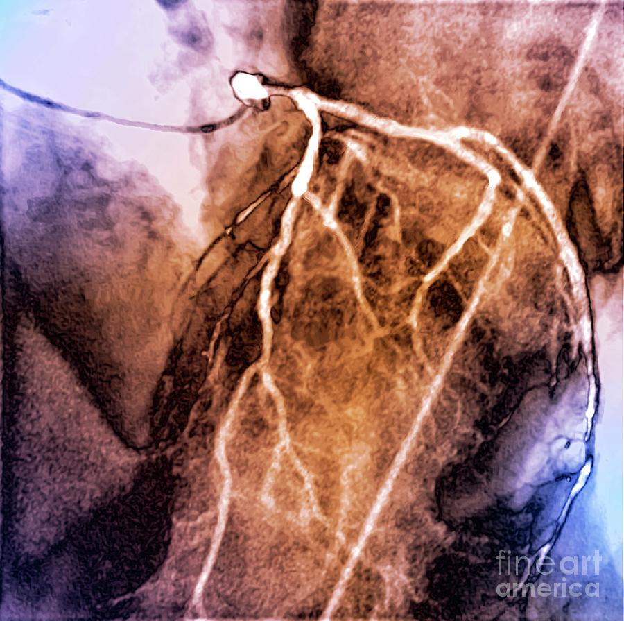Human Body Photograph - Left Coronary Artery #10 by Zephyr/science Photo Library