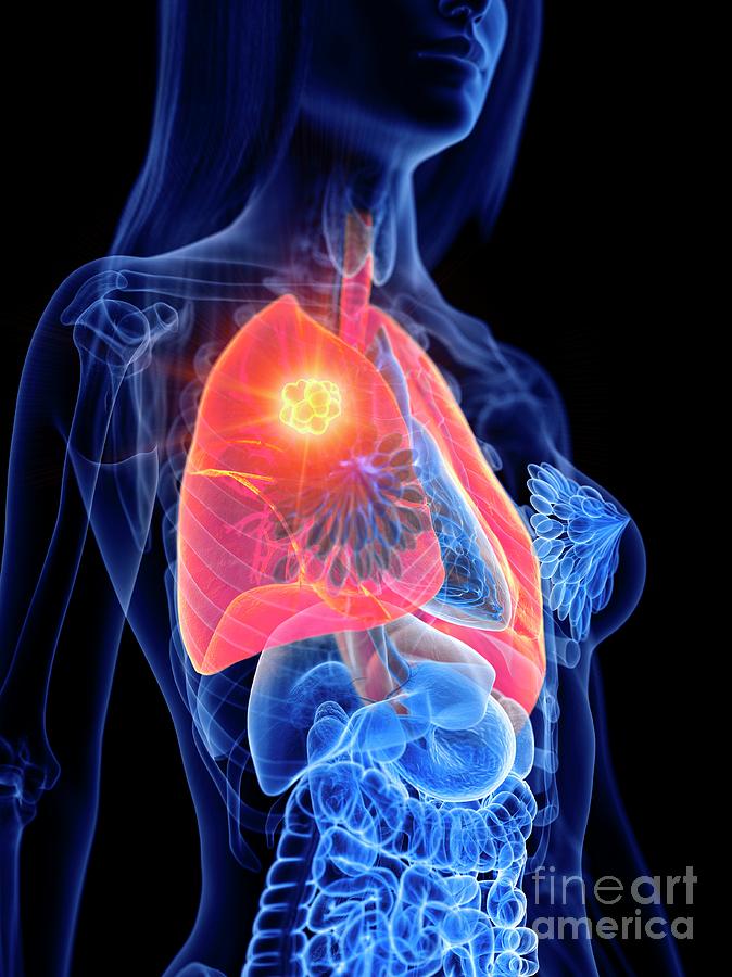 3d Photograph - Lung Cancer #10 by Sebastian Kaulitzki/science Photo Library