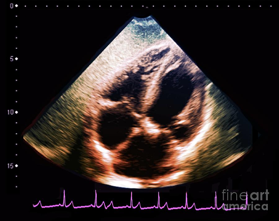 Normal Heart #10 Photograph by Zephyr/science Photo Library