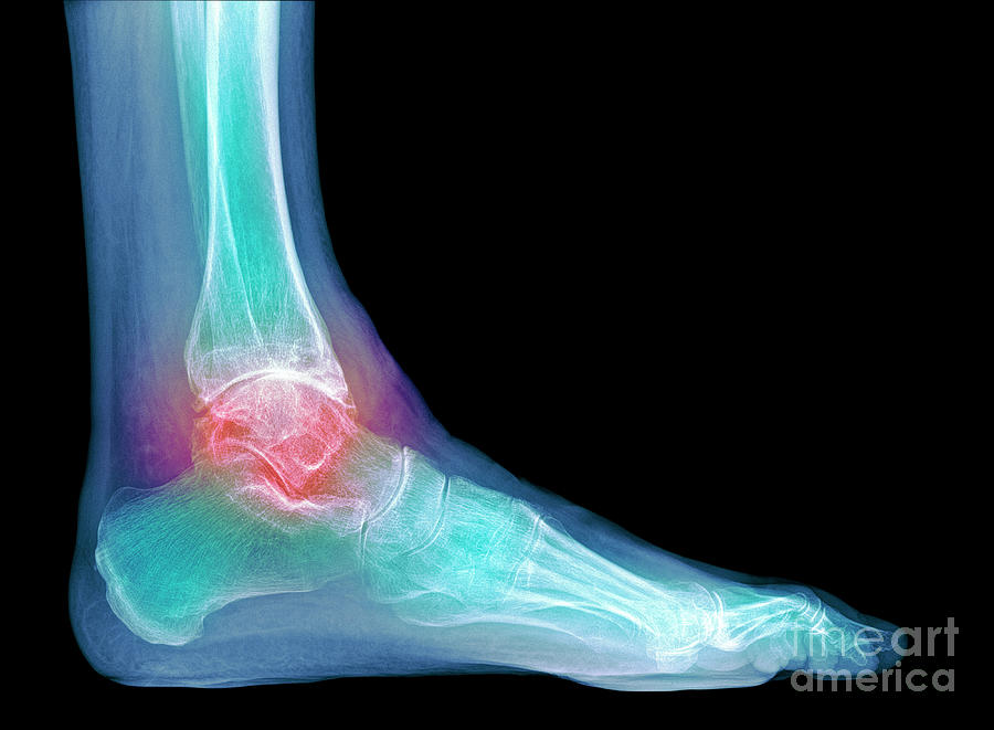 Osteoarthritis Of The Ankle Photograph By Dr P Marazzi Science Photo Library