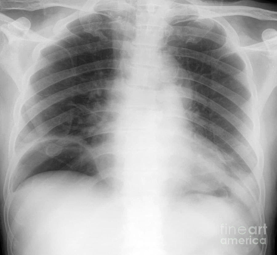 Pneumoperitoneum Photograph by Rajaaisya/science Photo Library - Fine ...