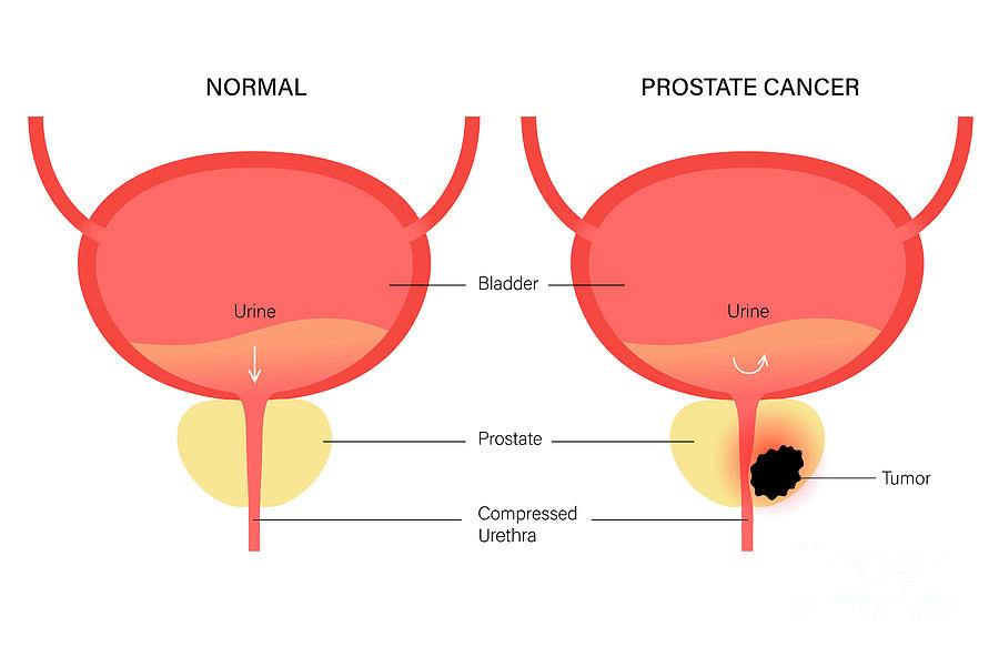 Prostate Cancer Photograph by Pikovit / Science Photo Library - Fine ...