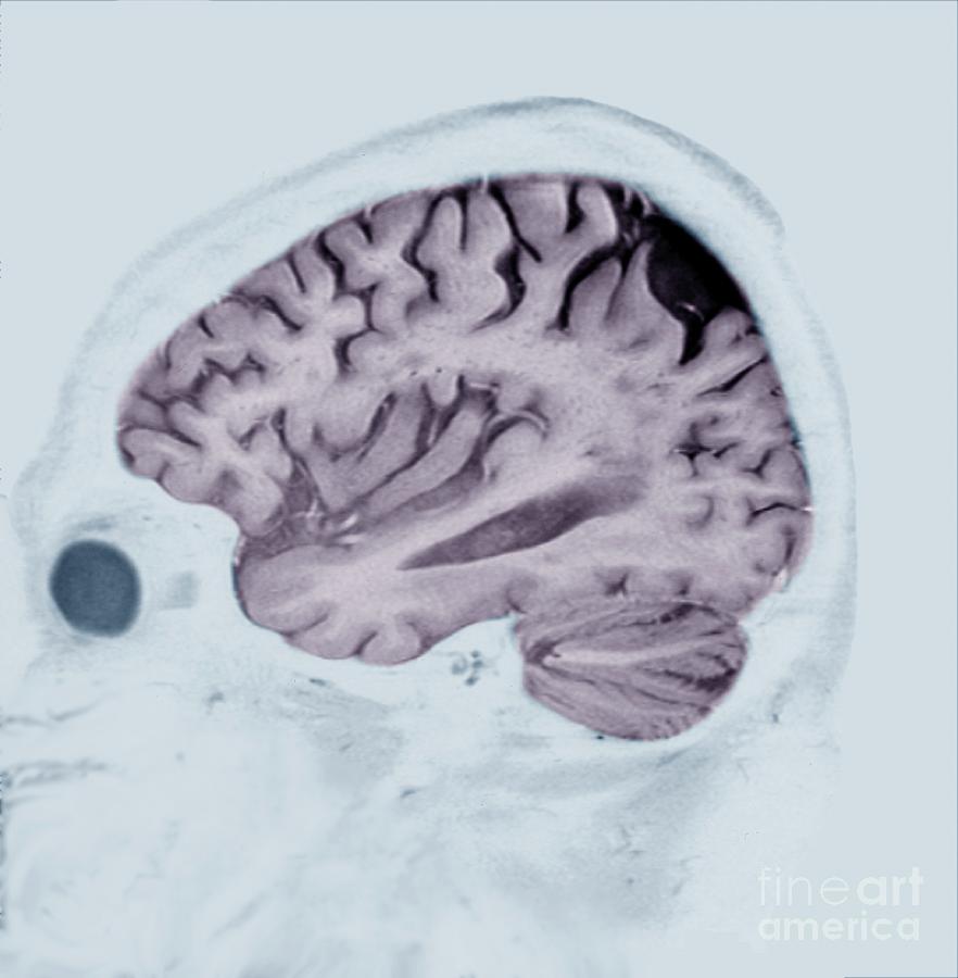 Alzheimers Disease #11 Photograph by Zephyr/science Photo Library