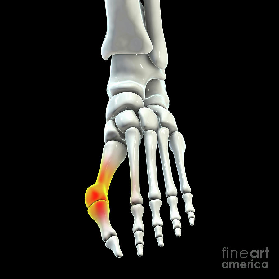 Bunion #11 Photograph by Kateryna Kon/science Photo Library
