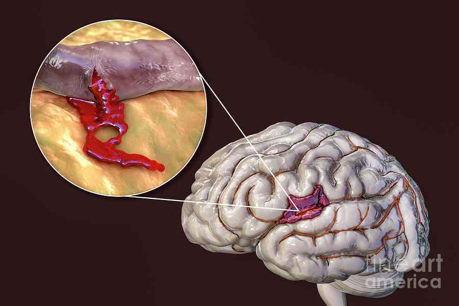 Haemorrhagic Stroke Photograph by Kateryna Kon/science Photo Library ...